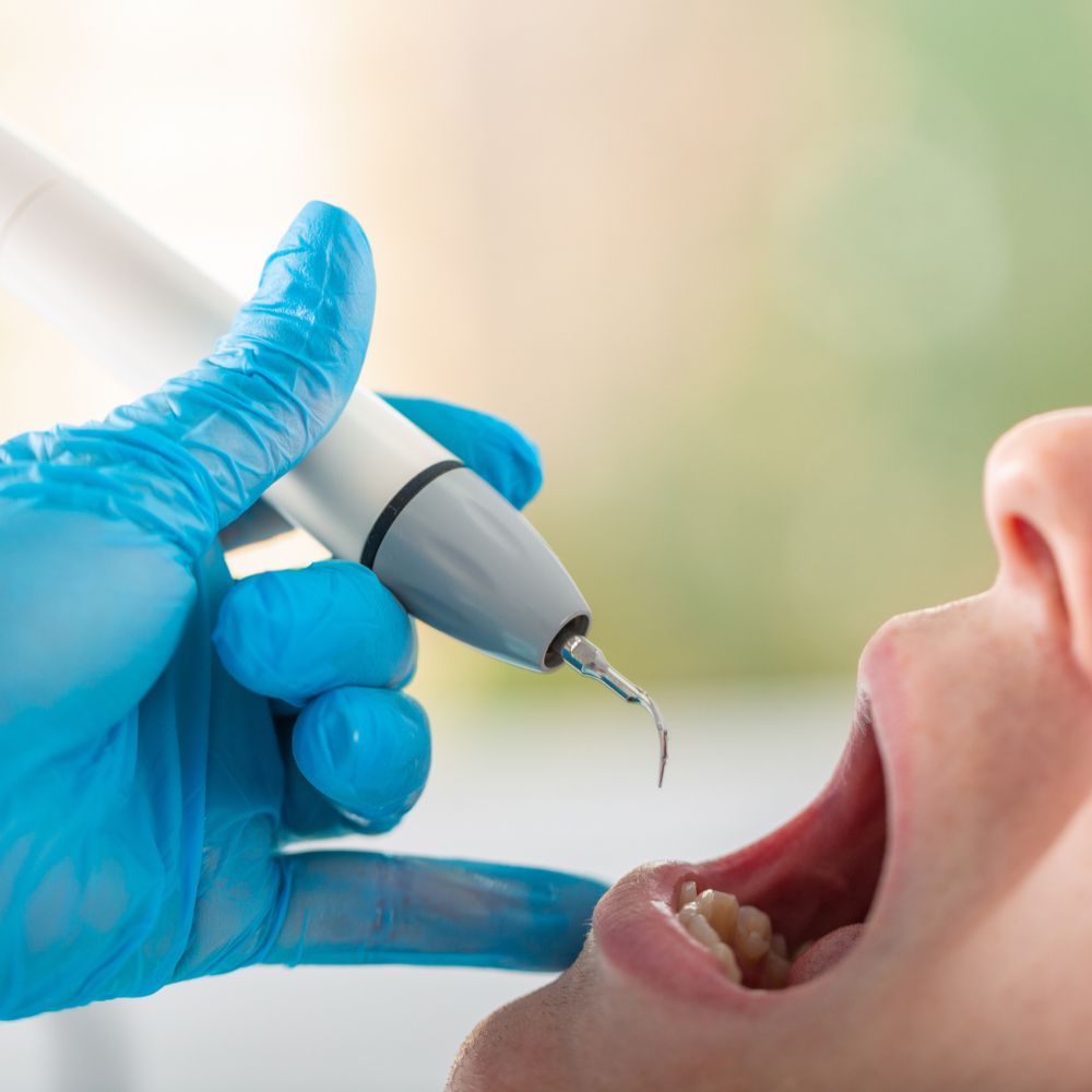 detartrage-surfacage-paris Parodontiste paris - Détartrage