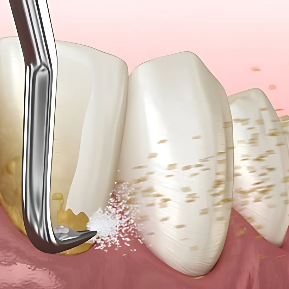 parodontiste-paris-parodontologie medicale Parodontiste paris - Détartrage